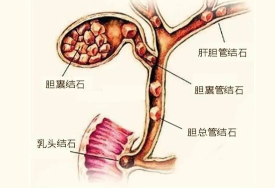 市五院多学科联动 ERCP治疗七旬胆梗阻患者化“阻”为通